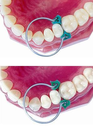 Add-On wedges (40 pcs box) - TOR VM